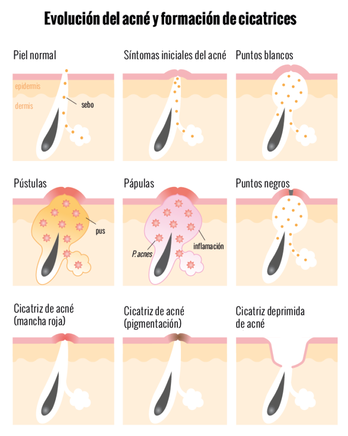 Formacin Del Acne 700x877